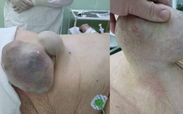 В Улан-Удэ 91-летней женщине удалили гигантскую грыжу живота