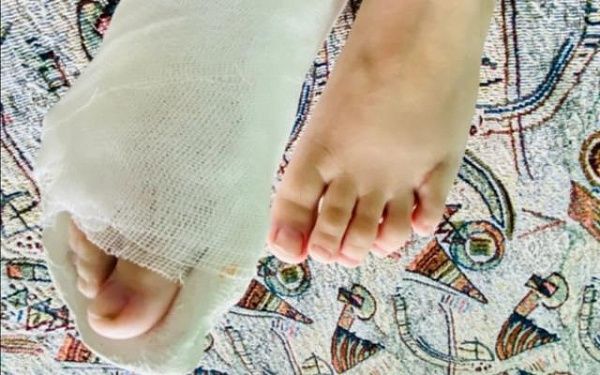 Бурятские врачи удалили "лишние" пальчики семилетней девочке из Забайкалья